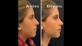 ENTREVISTA COM O MÉDICO DA MINHA RINOSSEPTOPLASTIA (RINOPLASTIA + DESVIO DE SÉPTO)| DR EDUARDO DOLCI