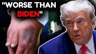 Trump's Melting Brain Is Getting Worse