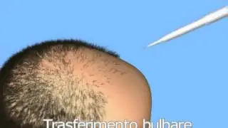 Sequenza Autotrapianto naser002