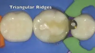 Complex Composite Restoration