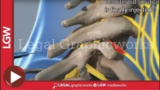 ESI Epidural Steroid Injection 3D animation