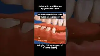 tooth bridge process full arch bridge,Smile Makeover #shorts