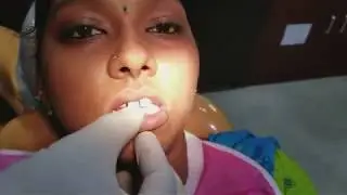 கீழ்  தாடை முன் பல் இல்லாமல் அவதிப்படுகிறீர்களா ? #lowerteethmissing #pfmcrowns