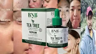 BNB Tea Tree Acne Control Serum | Honest Review