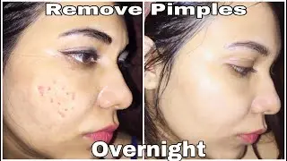 Best Gel for Acne and Pimples | Faceclin gel review | Faceclin gel | How to remove pimple overnight