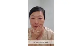 LING CHAN'S MASKNE SOLUTION: QUICK TREATMENT