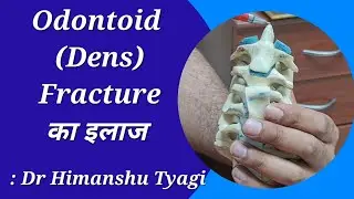 Odontoid / Dens Fracture का इलाज