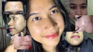 SKINCARE AJA GA CUKUP SEMBUHIN JERAWAT?????? INI CARA AKU SEMBUHIN JERAWATKU || acne journey EPS 1 