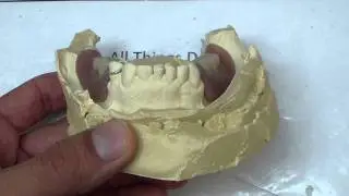 Removable Denture Clasp Repair Part 3 - Denture on Cast