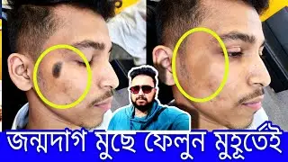 জন্মদাগ মুছে ফেলুন এক মুহূর্তে 😳Birthmark Removal Laser Treatment |  জন্মদাগ দূর করার উপায় 😯