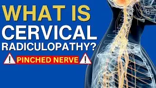 Understanding Cervical Radiculopathy, Nerve Compression, Neck Pain, Tingling & Numbness