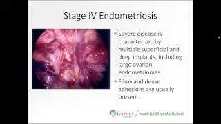 Overcoming Endometriosis: Strategies for Success - PART 1