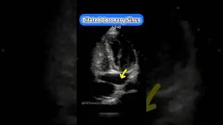 Coronary Sinus on Echocardiography #echocardiogram #cardiology #echo