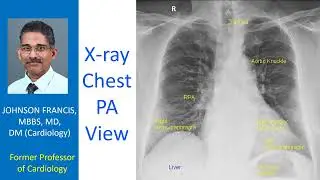 X-ray Chest PA View (CXR-PA)