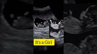 It's a baby girl: Nub Theory: Ultrasound case!!