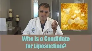 Who is a Candidate for Liposuction?