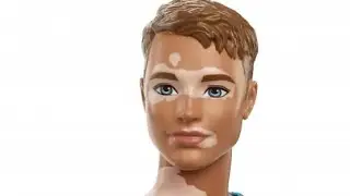 Ken Fashionistas 192 con vitiligo