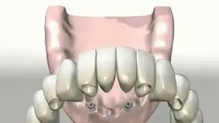 All On Four (нижняя челюсть)