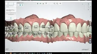 How To Use 3Shape Indirect Bonding Software with the BioQuick Bracket System