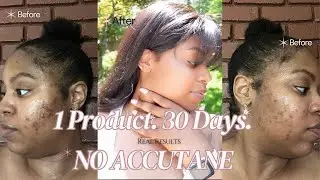 1 Month With 1 Product, NO Accutane | I Cleared My Cystic Acne FOR GOOD