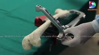 NEW ANTIGRADE FEMUR NAIL  Surgical Procedure Demonstration by DKSORTHO