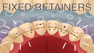 All About Fixed Retainers
