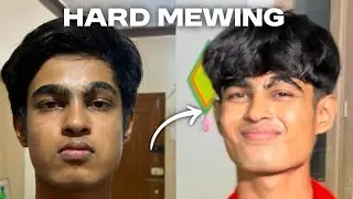 Hard Mewing Can Change Your Face | How To Do Hard Mewing | Hindi 