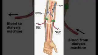AV fistula for dialysis#viral #shorts #short #shortvideo