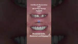Smile Makeover in Tulsa #dentalimplants #allon4 #oklahoma #tulsa #fourstrong #fullmouthrehab