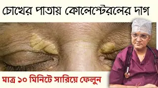 How to remove cholesterol spots On Eyelid | চোখের পাতায় কোলেস্টেরলের দাগ কমানোর পদ্ধতি