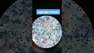 Liquid base cytology pap smear🔬👩🏻&zwj;🔬 ##cells @ankuharikanta