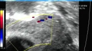 GRAVIMAGEM 4226 (ECOGRAFIA TRANSVAGINAL GESTAÇÃO DE 6 SEMANAS).mp4