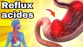 Ne mange pas ces aliments avec le REFLUX ACIDE