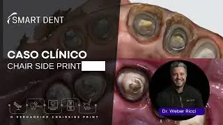 CASO CL&Iacute;NICO - Todas as possibilidades do sistema Chairside print