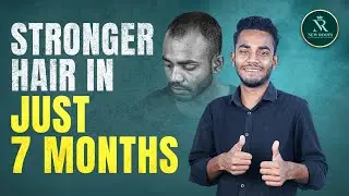 Grade 5 Baldness Cured in 7 Months 💥 | Hair Transplant Results in Bangladesh | New Roots
