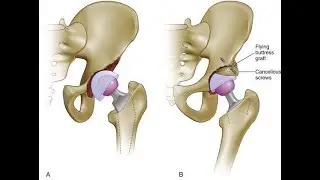 Reconstruction of acetabulum with prosthesis or graft; hip socket is damaged, deficient, or deformed