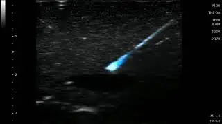 Follow the needle in real time: Ultrasound Guided Injections