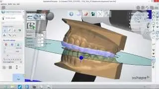 Bite Splint Design Workflow in 3Shape
