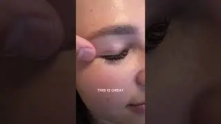 In Office Upper Bleph Before and after (upper eyelid surgery)