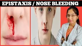 Epistaxis | Nose Bleeding | Causes | Types | Symptoms | Treatment | Complications
