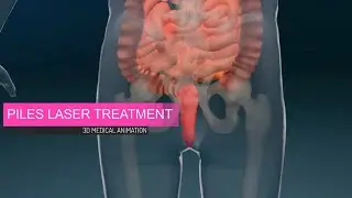 Piles Laser Treatment Explained | Modern, Painless Relief | Piles Best Treatment