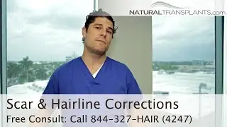 Hair Transplant Scar Corrections and Hairline Mistakes, Natural Transplants Fort Lauderdale / Miami