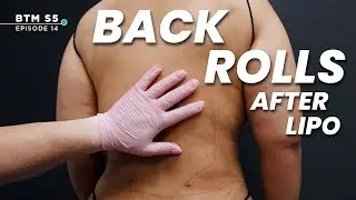 What Happens to Back Rolls After Liposuction?