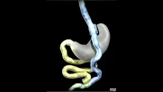 Episode 3 : Bariatric Procedures and Safety