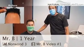 Natural Hair Transplants West Palm Beach, FL | Affordable Hair Transplants for Men