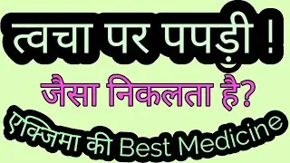 थकान के कारण किसी काम में मन नहीं लगता तो कौन सी दवा लें//Always Feeling Tired//Calc Sulph पार्ट वन