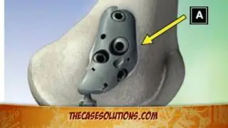 Moximed Inc. Case Solution  Analysis- TheCaseSolutions.com