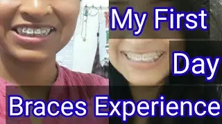 First Day Braces journey experience ,Metal Braces, पहला दिन दातो के तार का अनुभव