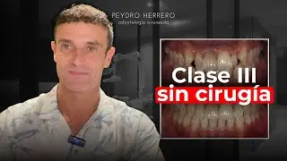 Clase III: cómo corregir una maloclusión severa SIN cirugía ni extracciones | Ortodoncia invisible