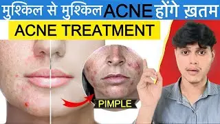 4 Days Acne Treatment For All Time | Homeremedy Facepack for Pimples/Acne